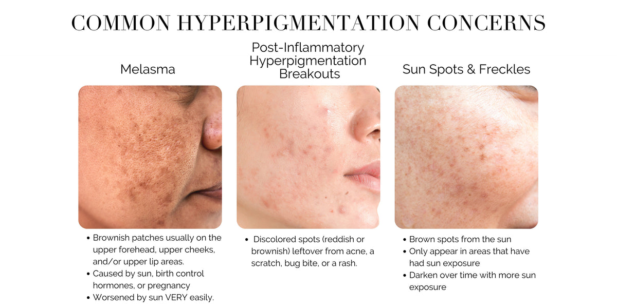 How to Get Rid of Hyperpigmentation & Dark Spots: Treatment Plan — Derm ...