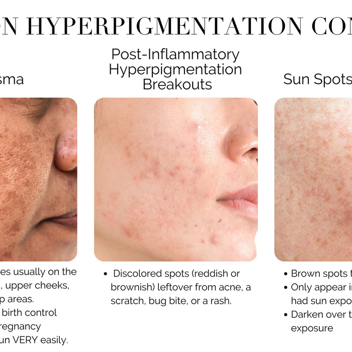 How to Get Rid of Hyperpigmentation & Dark Spots