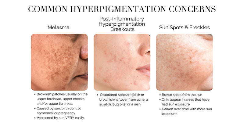 hyperpigmentation acne