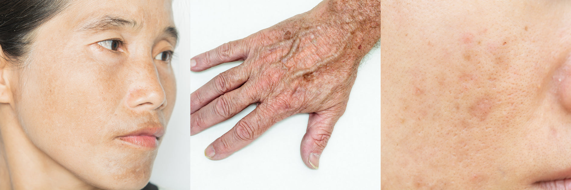 What is Hyperpigmentation & What Causes Dark Spots on Skin? — Derm to Door