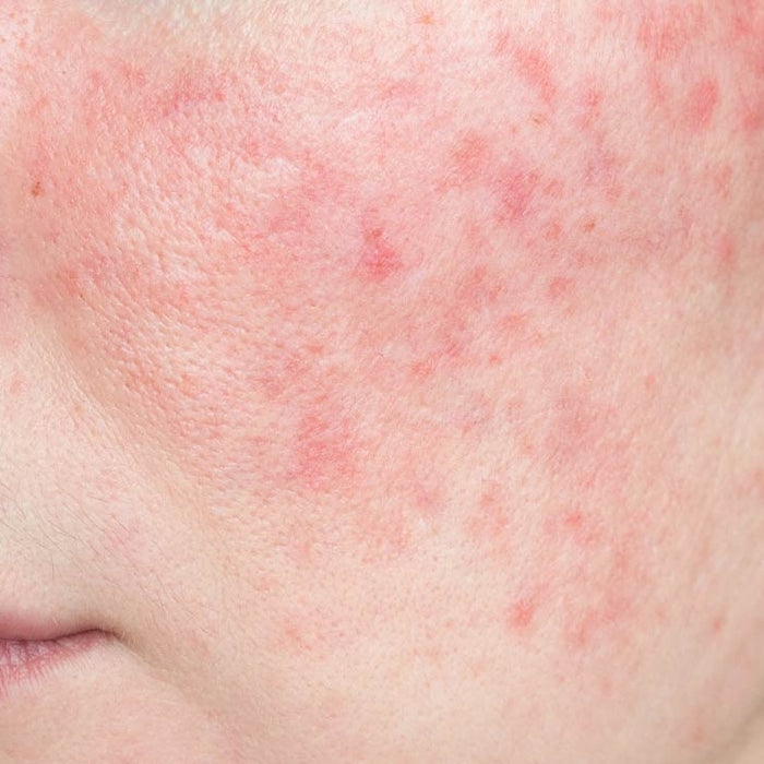 What is Rosacea & What Causes Red, Sensitive Skin?