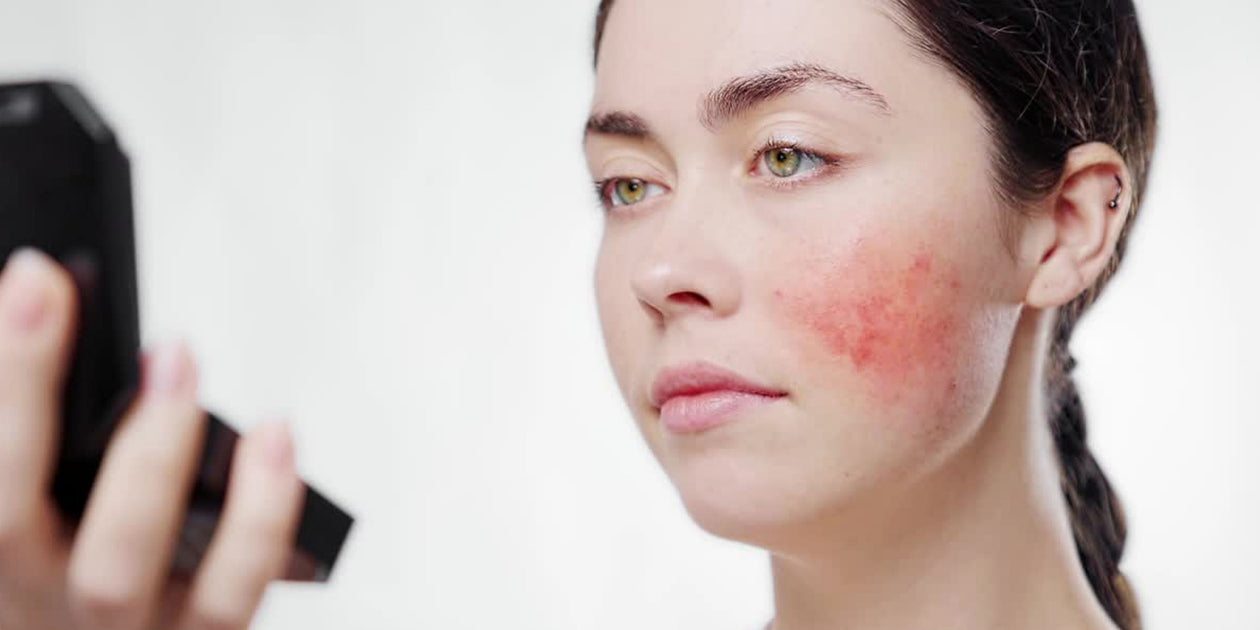 How to Get Rid of Rosacea: The Best Skincare for Red, Sensitive Skin — Derm  to Door