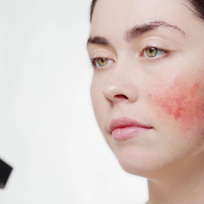 How to Update Your Skincare Routine for Rosacea Prone Skin | Derm to Door