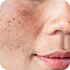 Treament