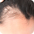 Treament