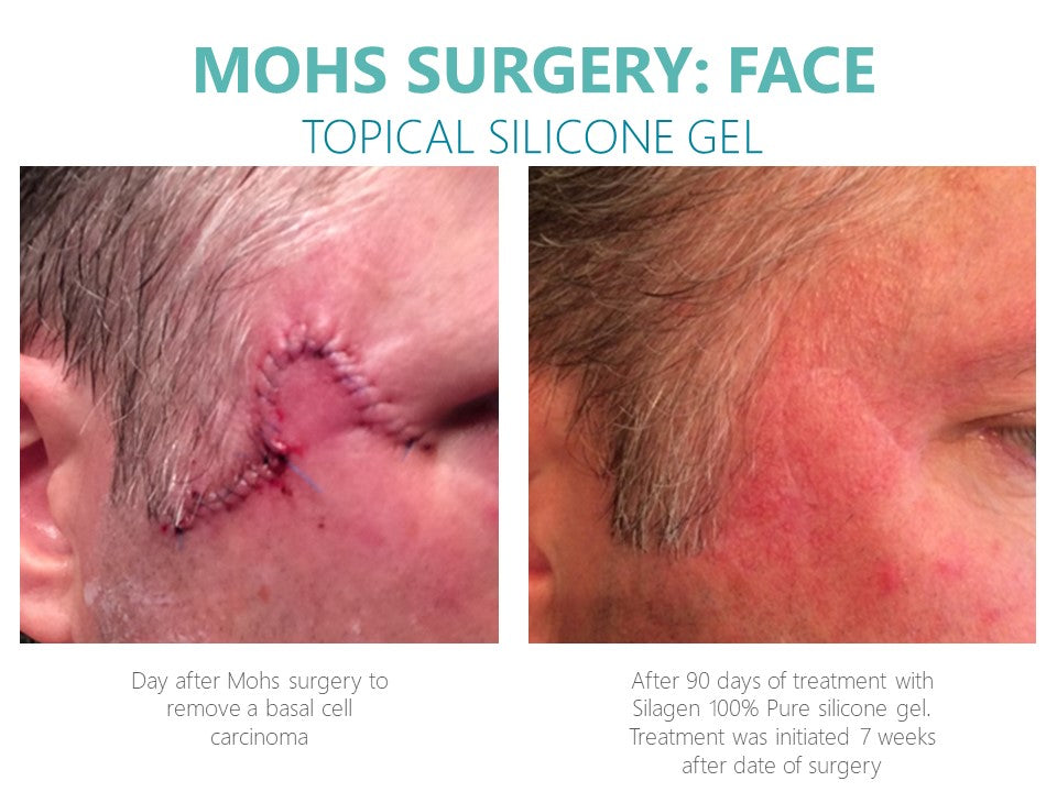 NEW Silagen 100% Pure Silicone deals Gel for Scars