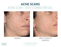 Silagen Acne Scar + Spot Corrector 30g