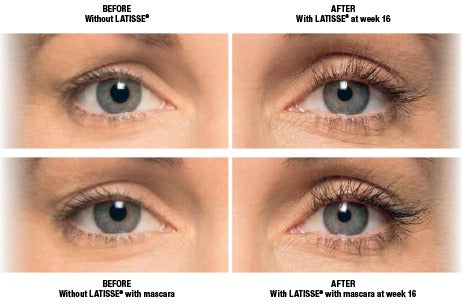 Latisse Eyelash Growth Serum